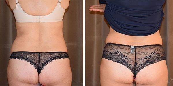 CoolSculpting före och efter