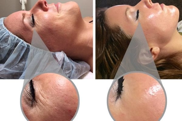 4 månander mellan före- och efterbild på Pure Retinol Peel kemiska behandlingenn