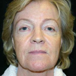 Före Ansiktslyft och endoskopiskt pannlyft