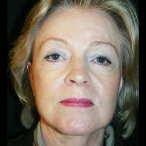 Efter Ansiktslyft och endoskopiskt pannlyft