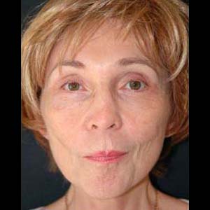 Efter Ansiktslyft med endoskopisk pannlyftning