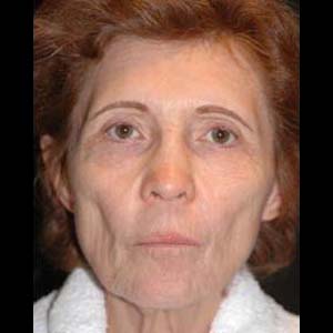 Före Ansiktslyft med endoskopisk pannlyftning