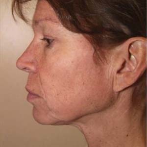 Före "Ansiktslyft och endoskopiskt pannlyft samt undre ögonlocksplastik med fettransposition och fettsugning av hals"