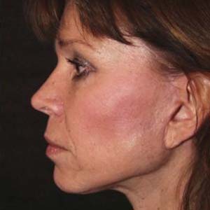 Efter "Ansiktslyft och endoskopiskt pannlyft samt undre ögonlocksplastik med fettransposition och fettsugning av hals"