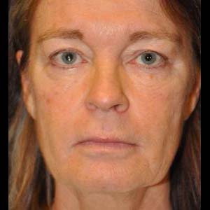 Före Ansiktslyft, halslyft.