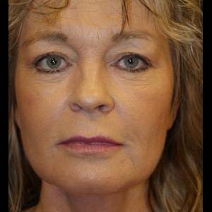 Efter Ansiktslyft, halslyft.