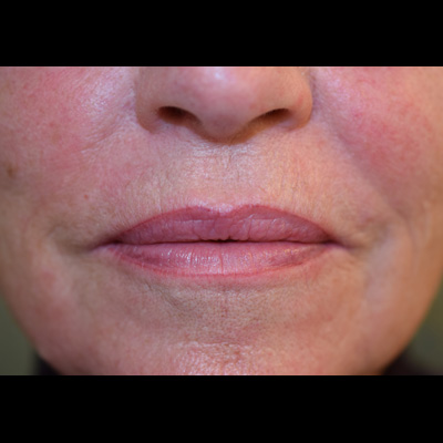 Patient efter permanent lippliner