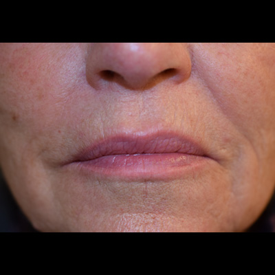 Patient innan permanent lippliner