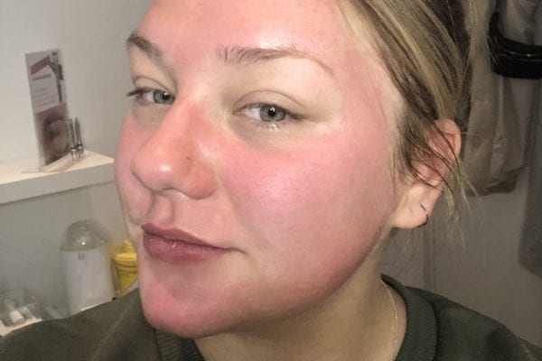 Kajsa Linnea efter en Aquagold behandling