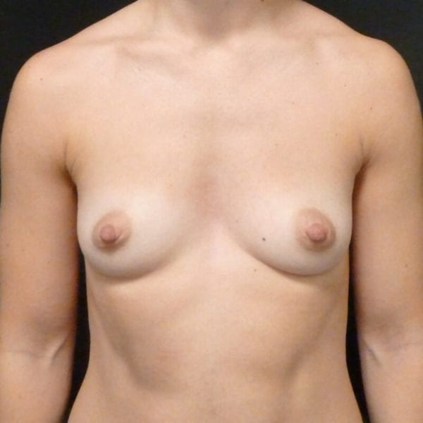 Byst efter bröstförstoring