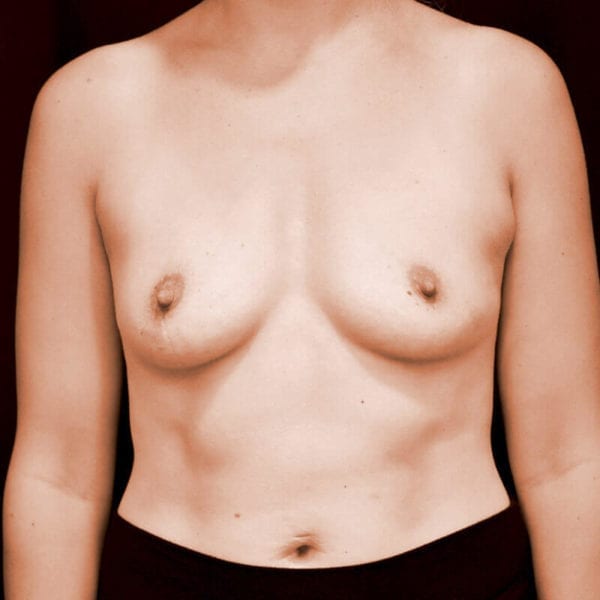 Byst framifrån innan bröstförstoring 181487