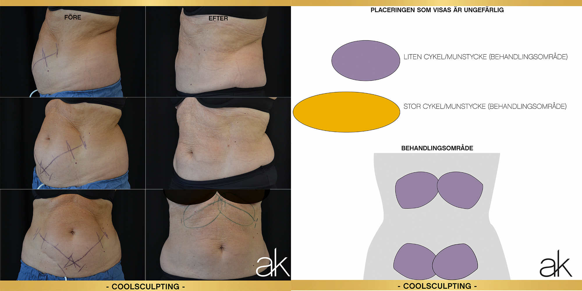 Före och efter CoolSculpting behandling