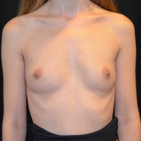 Byst framifrån innan bröstförstoring 178140