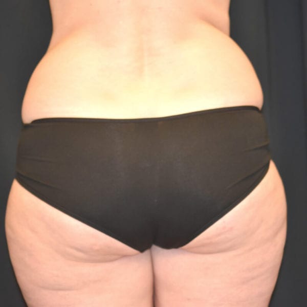 Lår bakifrån innan fettransplantation till bröst Akademikliniken