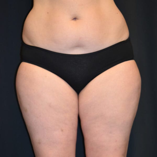 Lår framifrån innan fettransplantation till bröst Akademikliniken