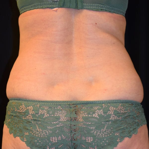 Patient innan CoolSculpting bakifrån 121861