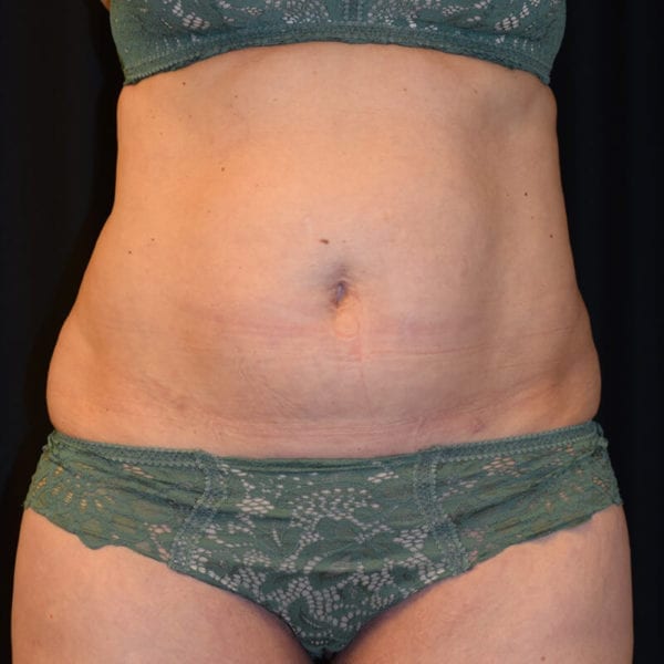 Patient innan CoolSculpting framifrån 121861