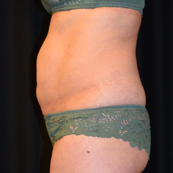 Patient innan CoolSculpting från sidan 121861