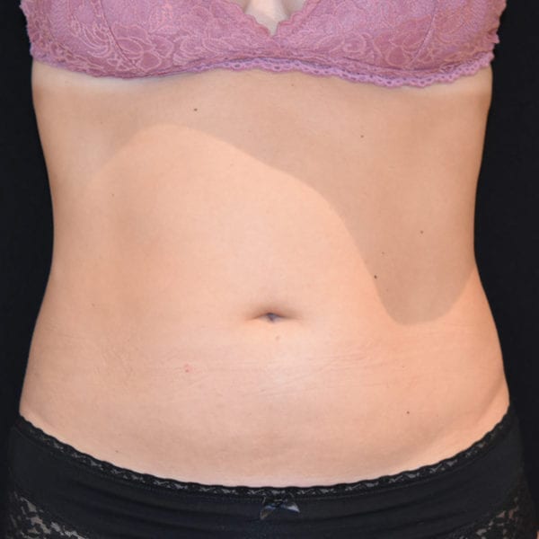 Patient framfrån efter CoolSculpting behandling 105832