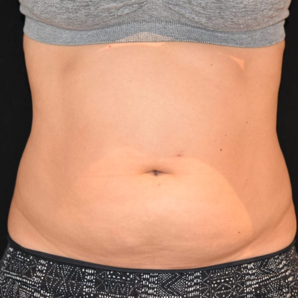 Patient framifrån innan CoolSculpting behandling 105832