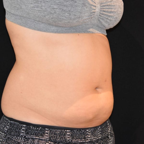 Patient snett från sidan innan CoolSculpting behandling 105832